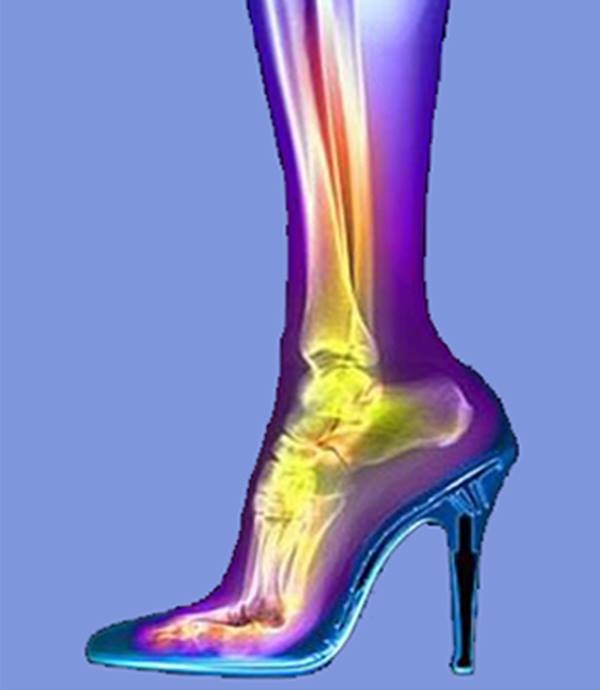 xray_FootInHeel.jpg